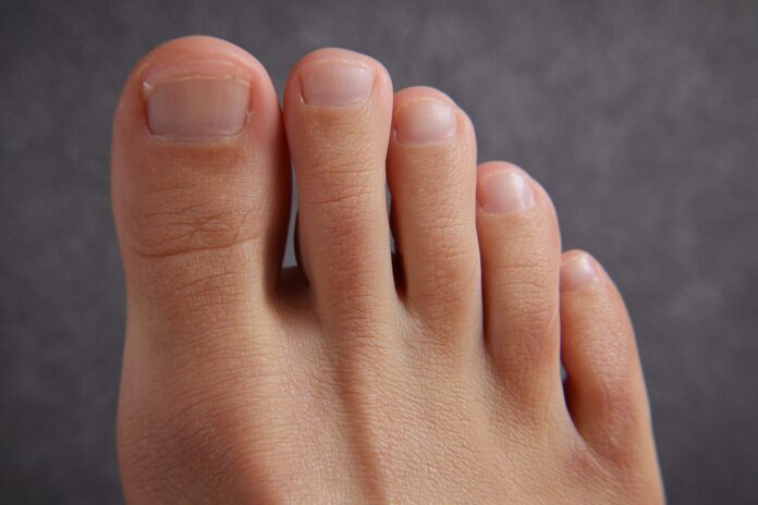 Close-up of toes showing natural interdigital skin fold