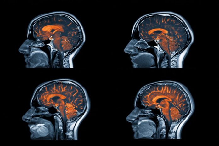 MRI scans showing increased activity in the orbitofrontal cortex of an OCD patient.